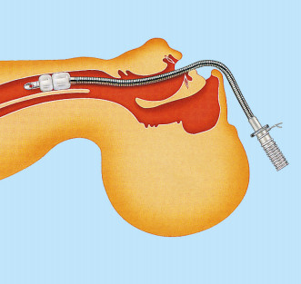 Hot Sale Stainless Steel Laser Resistant Endotracheal Tube for Laser Surgery
